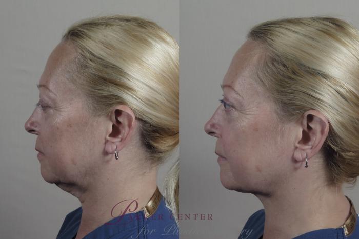 Neck Contouring Case 986 Before & After Right Side | Paramus, NJ | Parker Center for Plastic Surgery