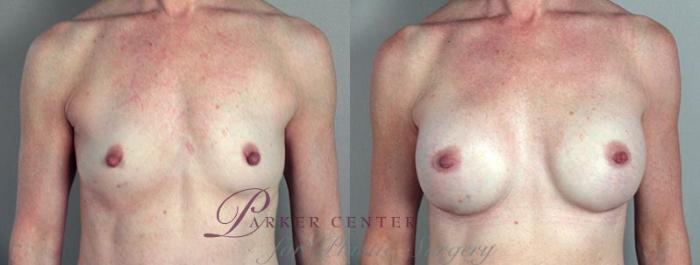 Nipple Procedures Case 363 Before & After View #1 | Paramus, NJ | Parker Center for Plastic Surgery