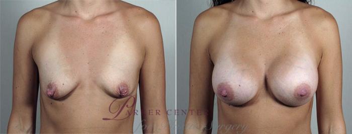 Nipple Procedures Case 429 Before & After View #1 | Paramus, NJ | Parker Center for Plastic Surgery