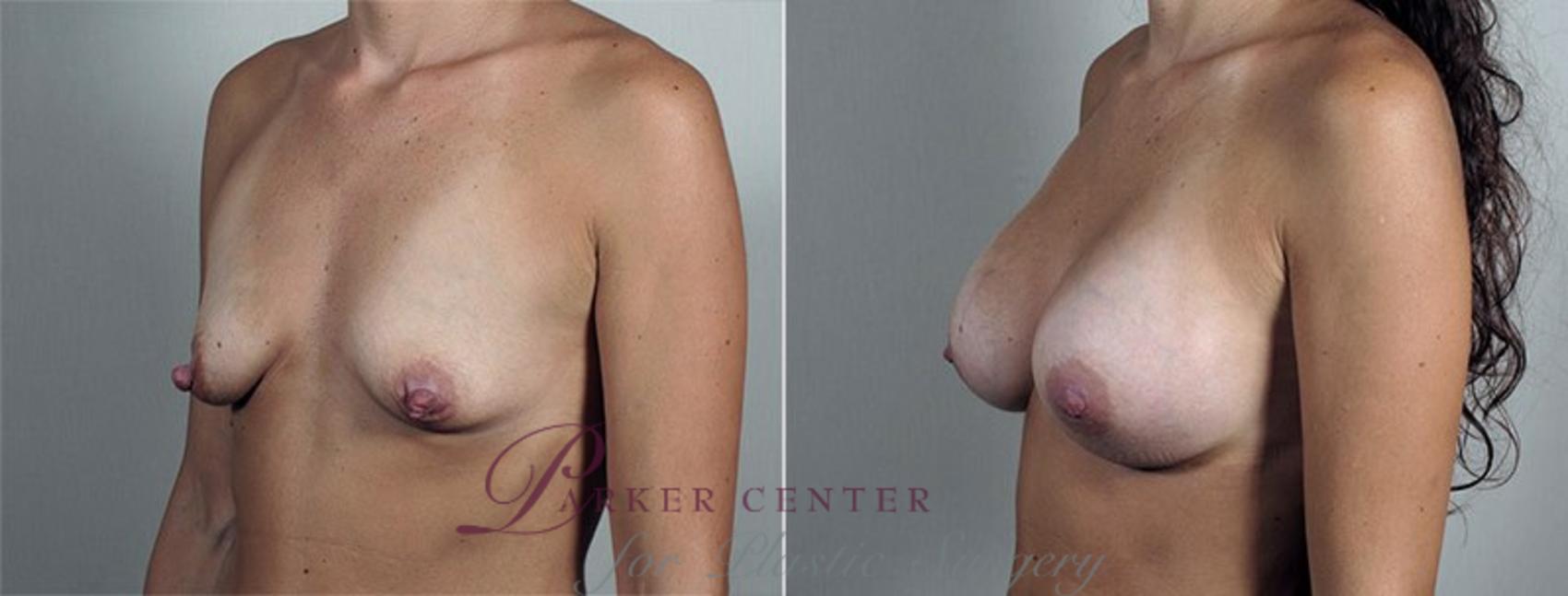 Nipple Procedures Case 429 Before & After View #2 | Paramus, NJ | Parker Center for Plastic Surgery