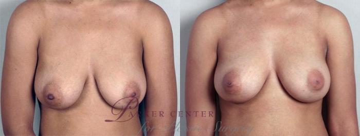 Nipple Procedures Case 559 Before & After View #1 | Paramus, NJ | Parker Center for Plastic Surgery