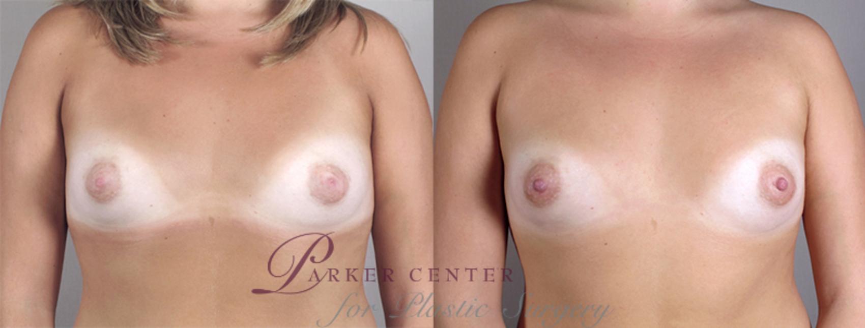 Nipple Procedures Case 560 Before & After View #1 | Paramus, NJ | Parker Center for Plastic Surgery
