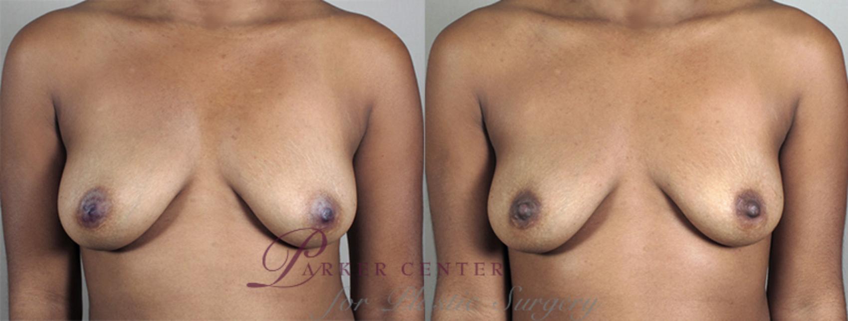 Nipple Procedures Case 561 Before & After View #1 | Paramus, NJ | Parker Center for Plastic Surgery