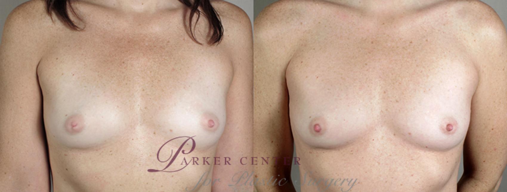 Nipple Procedures Case 562 Before & After View #1 | Paramus, NJ | Parker Center for Plastic Surgery