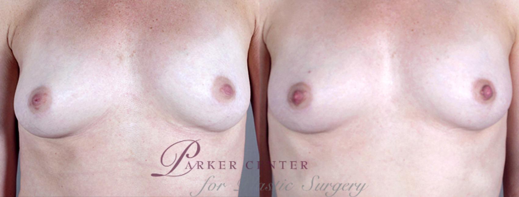 Nipple Procedures Case 563 Before & After View #1 | Paramus, NJ | Parker Center for Plastic Surgery