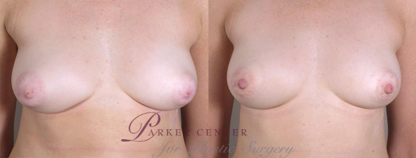 Nipple Procedures Case 564 Before & After View #1 | Paramus, NJ | Parker Center for Plastic Surgery