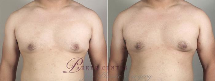 Nipple Procedures Case 565 Before & After View #1 | Paramus, NJ | Parker Center for Plastic Surgery