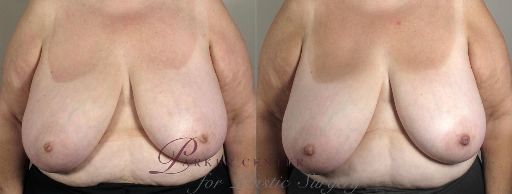 Nipple Procedures Case 566 Before & After View #1 | Paramus, NJ | Parker Center for Plastic Surgery