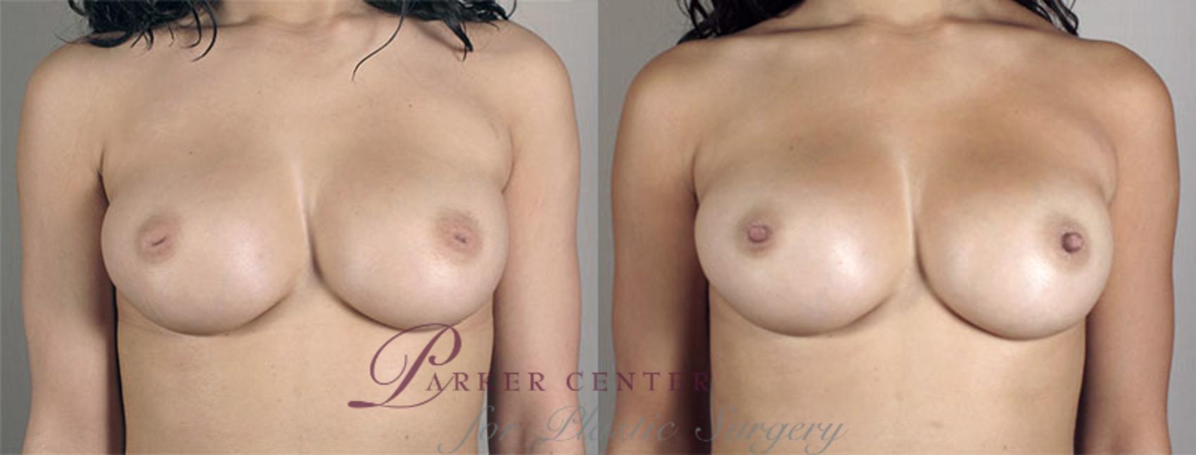 Nipple Procedures Case 567 Before & After View #1 | Paramus, NJ | Parker Center for Plastic Surgery