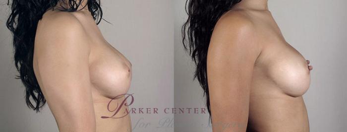 Nipple Procedures Case 567 Before & After View #2 | Paramus, NJ | Parker Center for Plastic Surgery