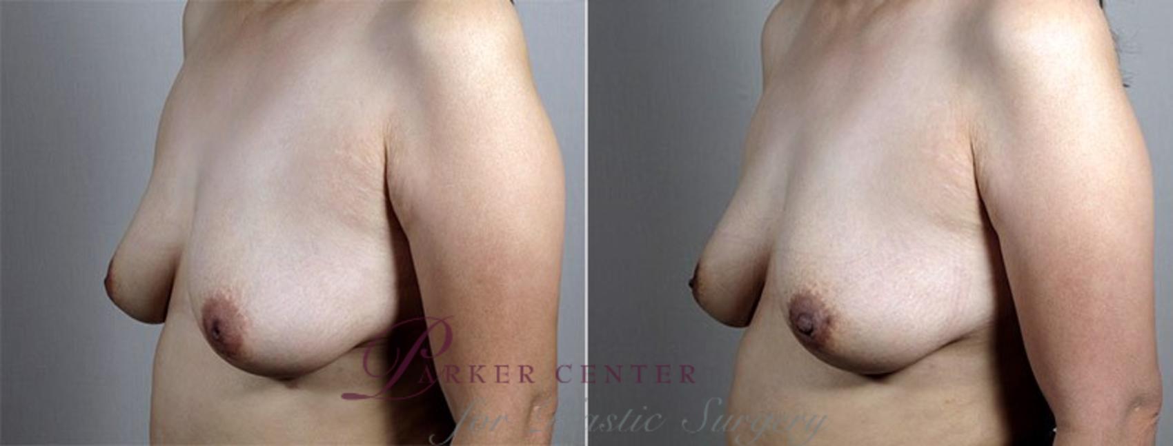 Nipple Procedures Case 568 Before & After View #1 | Paramus, NJ | Parker Center for Plastic Surgery