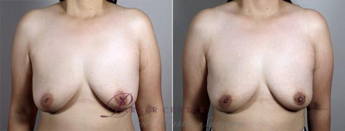 Nipple Procedures Case 568 Before & After View #2 | Paramus, NJ | Parker Center for Plastic Surgery