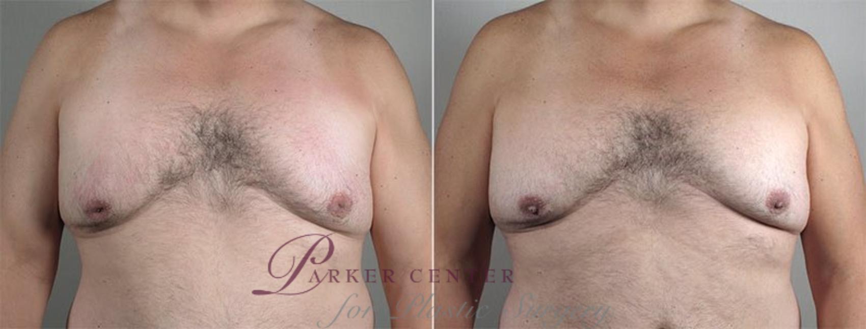 Nipple Procedures Case 569 Before & After View #1 | Paramus, NJ | Parker Center for Plastic Surgery