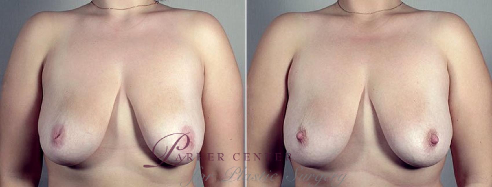 Nipple Procedures Case 570 Before & After View #1 | Paramus, NJ | Parker Center for Plastic Surgery
