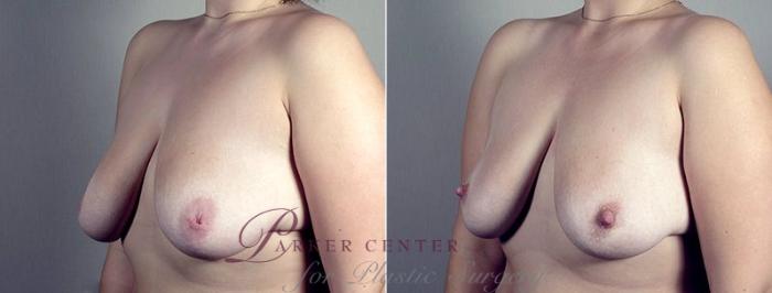 Nipple Procedures Case 570 Before & After View #2 | Paramus, NJ | Parker Center for Plastic Surgery