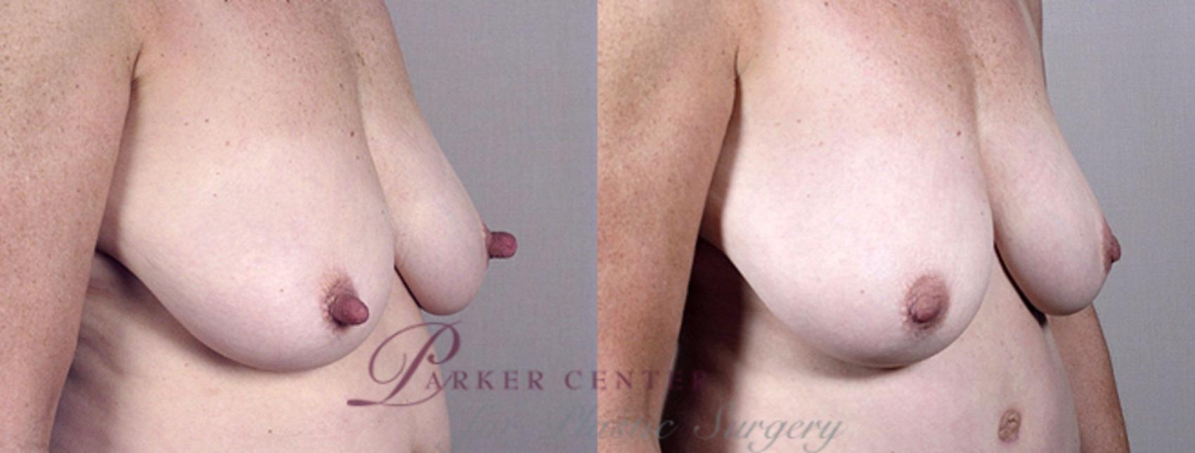 Nipple Procedures Case 571 Before & After View #1 | Paramus, NJ | Parker Center for Plastic Surgery