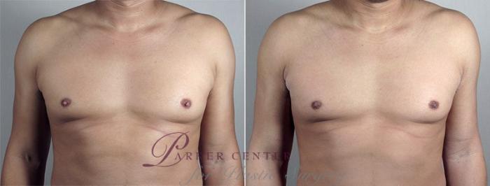 Nipple Procedures Case 572 Before & After View #1 | Paramus, NJ | Parker Center for Plastic Surgery