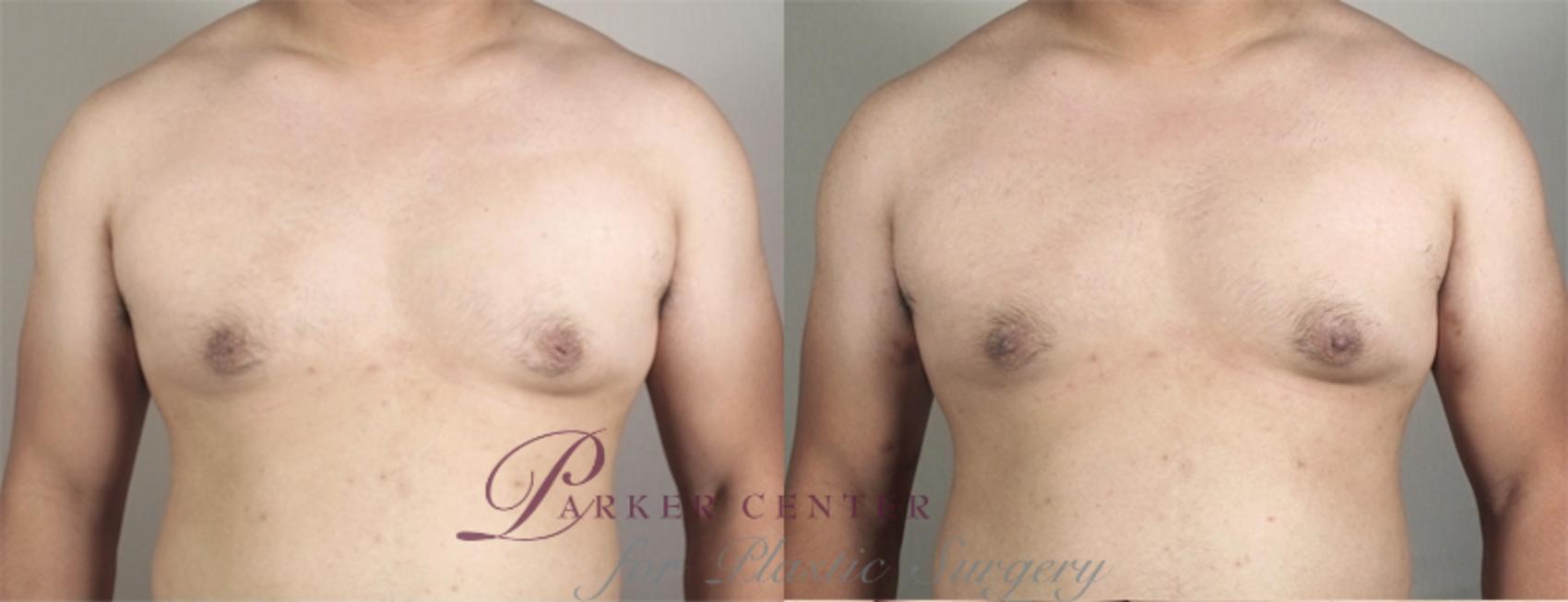 Nipple Procedures Case 941 Before & After View #5 | Paramus, NJ | Parker Center for Plastic Surgery