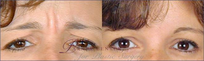 Nonsurgical Face Procedures Case 268 Before & After View #1 | Paramus, NJ | Parker Center for Plastic Surgery