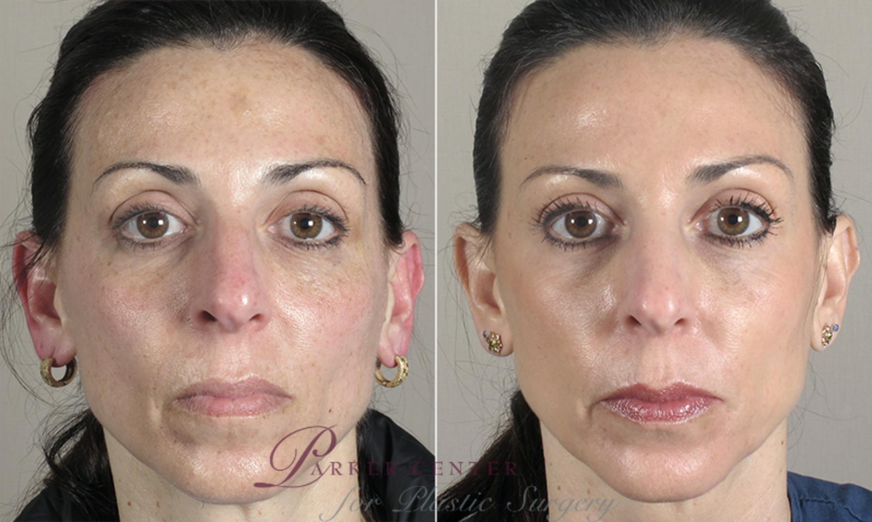 Nonsurgical Face Procedures Case 280 Before & After View #1 | Paramus, NJ | Parker Center for Plastic Surgery