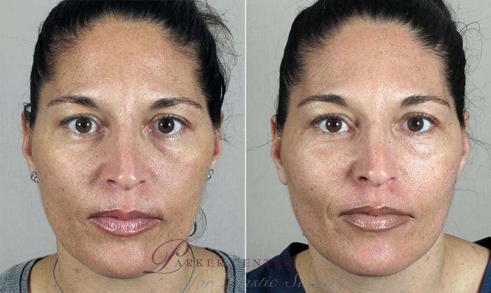 Nonsurgical Face Procedures Case 282 Before & After View #1 | Paramus, NJ | Parker Center for Plastic Surgery