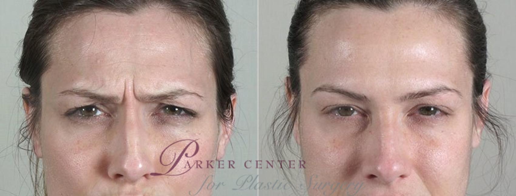 Nonsurgical Face Procedures Case 289 Before & After View #2 | Paramus, NJ | Parker Center for Plastic Surgery