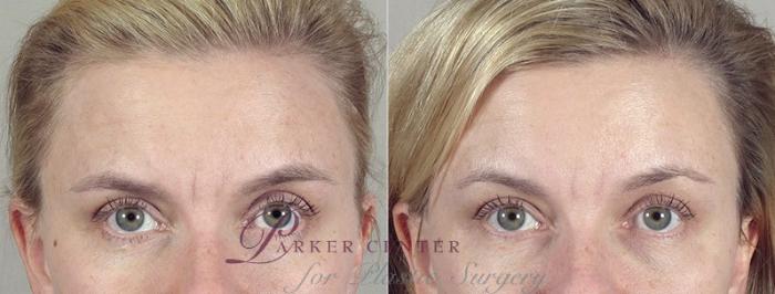 Nonsurgical Face Procedures Case 294 Before & After View #1 | Paramus, NJ | Parker Center for Plastic Surgery