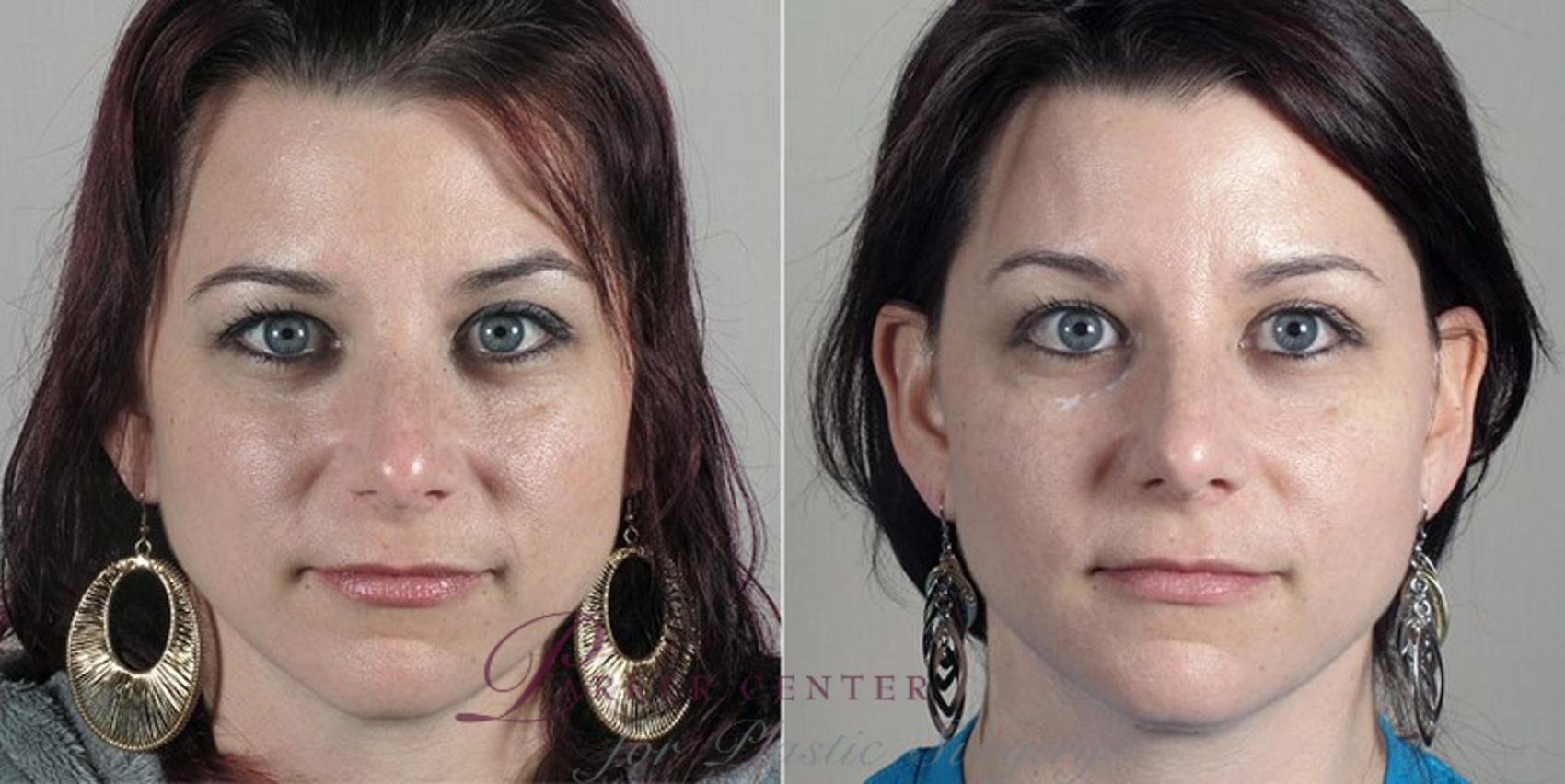 Nonsurgical Face Procedures Case 295 Before & After View #1 | Paramus, NJ | Parker Center for Plastic Surgery