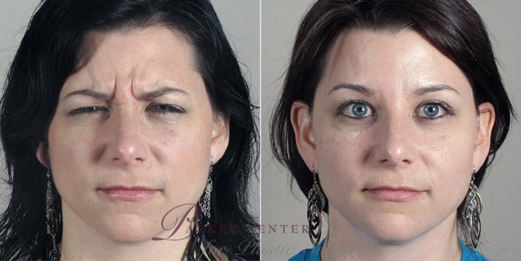 Nonsurgical Face Procedures Case 295 Before & After View #2 | Paramus, NJ | Parker Center for Plastic Surgery