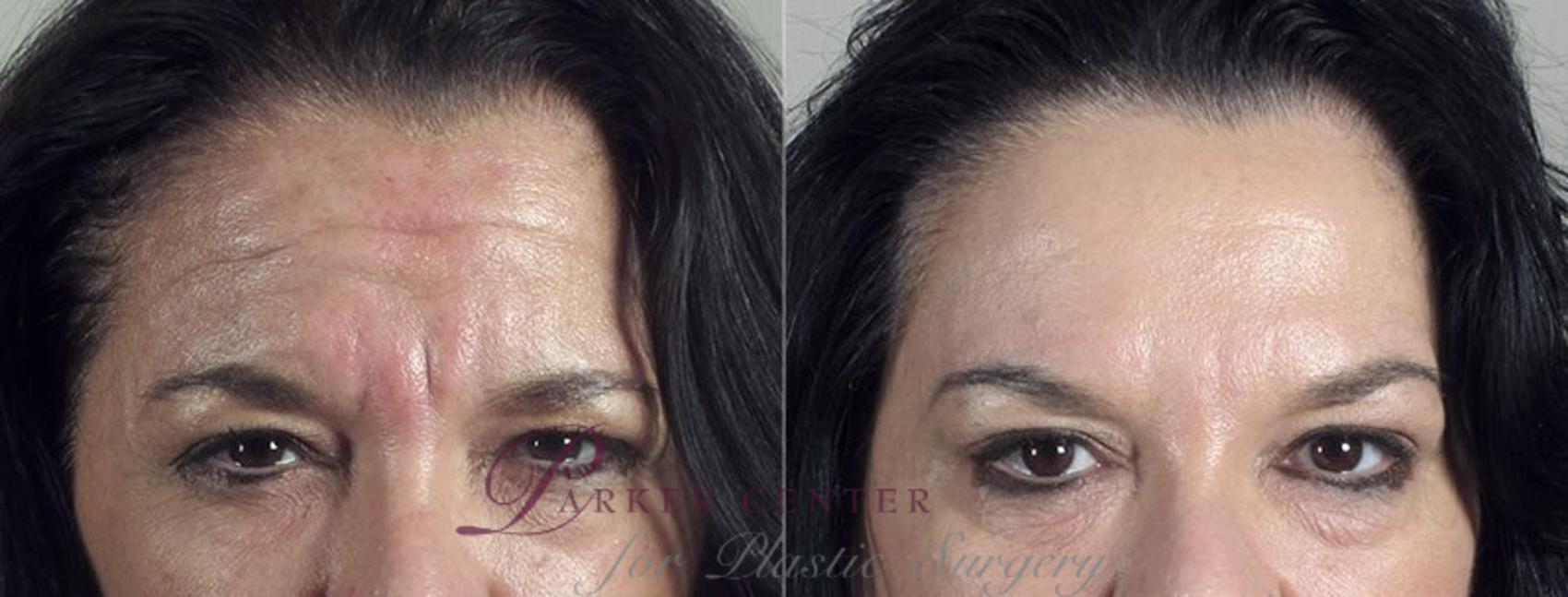 Nonsurgical Face Procedures Case 296 Before & After View #1 | Paramus, NJ | Parker Center for Plastic Surgery