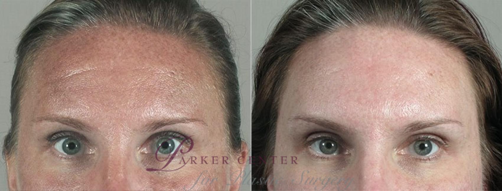 Nonsurgical Face Procedures Case 297 Before & After View #1 | Paramus, NJ | Parker Center for Plastic Surgery