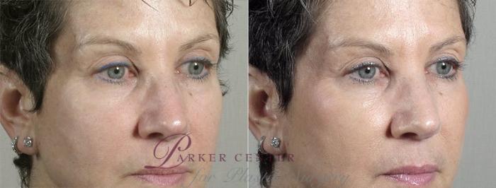 Nonsurgical Face Procedures Case 307 Before & After View #2 | Paramus, NJ | Parker Center for Plastic Surgery