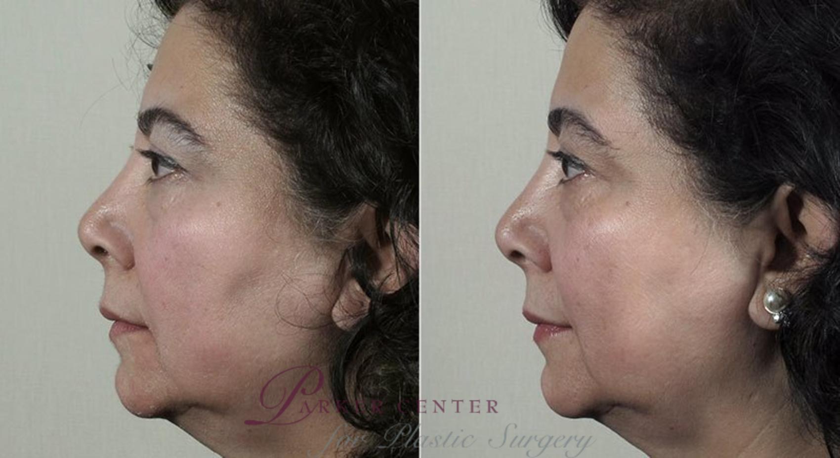 Nonsurgical Face Procedures Case 308 Before & After View #1 | Paramus, NJ | Parker Center for Plastic Surgery