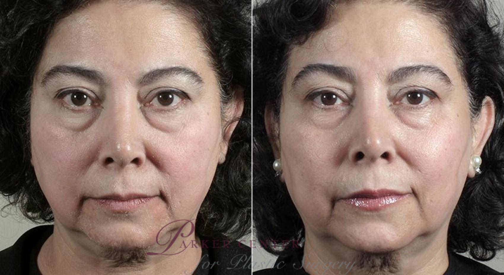 Nonsurgical Face Procedures Case 308 Before & After View #3 | Paramus, NJ | Parker Center for Plastic Surgery