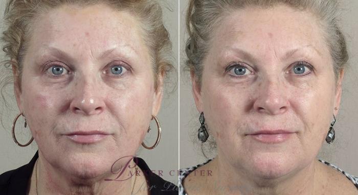 Nonsurgical Face Procedures Case 310 Before & After View #1 | Paramus, NJ | Parker Center for Plastic Surgery