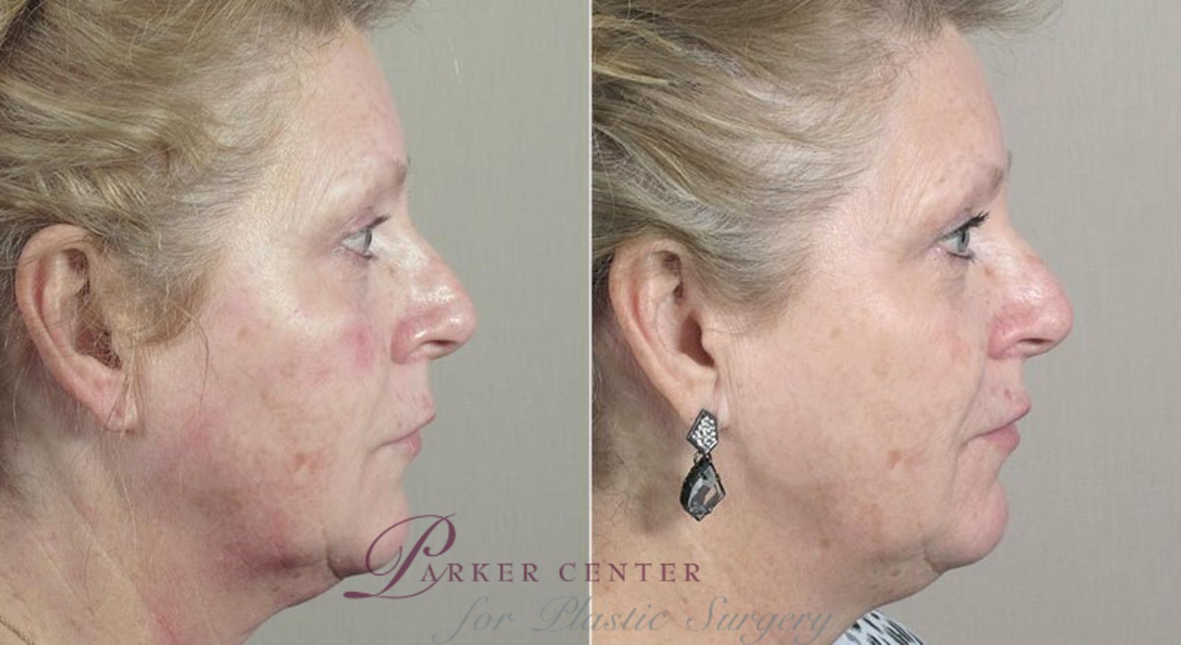 Nonsurgical Face Procedures Case 310 Before & After View #3 | Paramus, NJ | Parker Center for Plastic Surgery