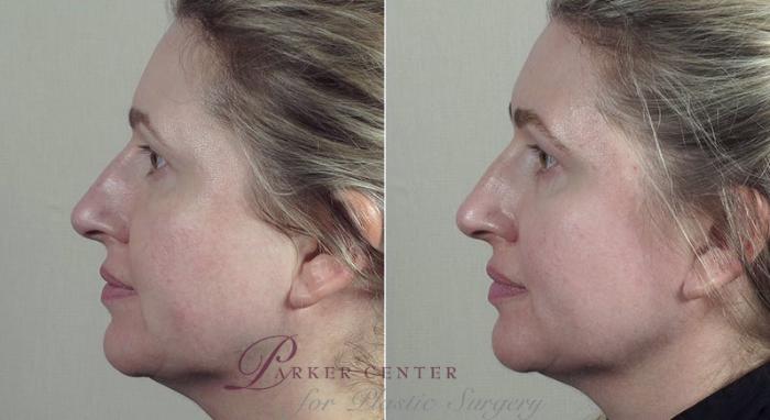 Nonsurgical Face Procedures Case 311 Before & After View #1 | Paramus, NJ | Parker Center for Plastic Surgery