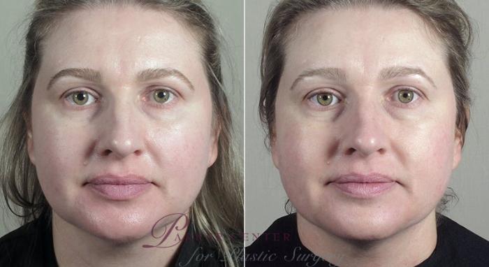 Nonsurgical Face Procedures Case 311 Before & After View #2 | Paramus, NJ | Parker Center for Plastic Surgery