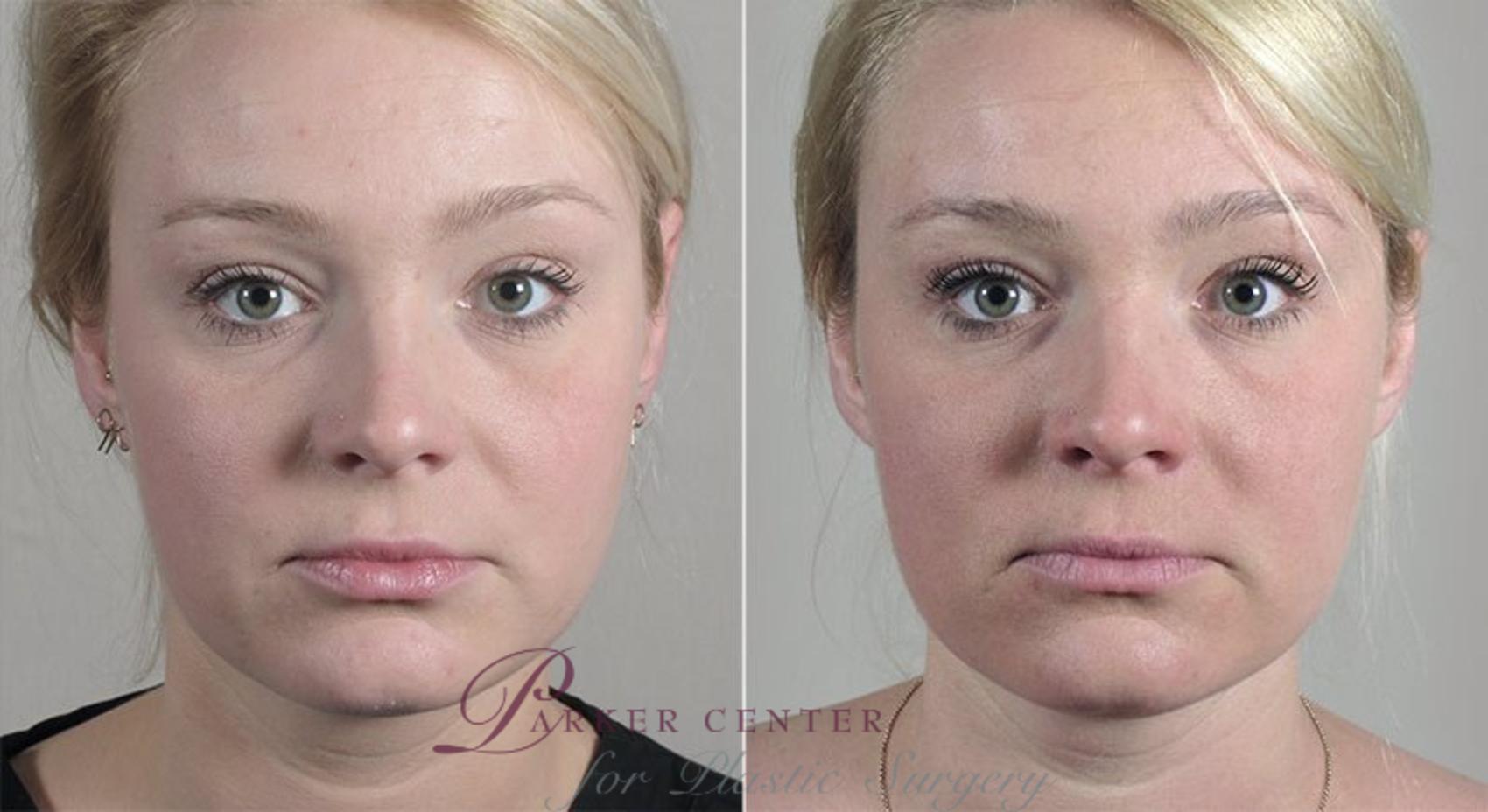 Nonsurgical Face Procedures Case 312 Before & After View #1 | Paramus, NJ | Parker Center for Plastic Surgery