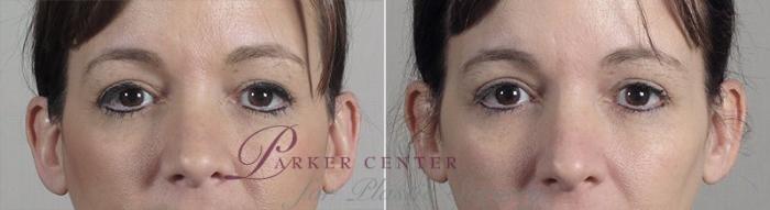 Nonsurgical Face Procedures Case 314 Before & After View #1 | Paramus, NJ | Parker Center for Plastic Surgery