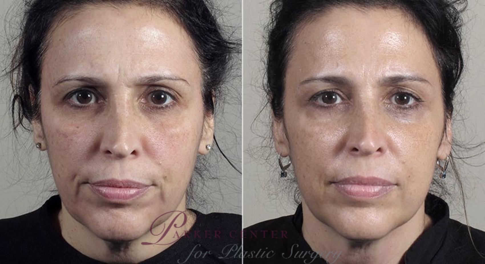 Nonsurgical Face Procedures Case 316 Before & After View #1 | Paramus, NJ | Parker Center for Plastic Surgery