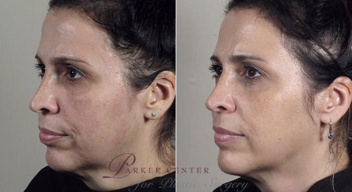 Nonsurgical Face Procedures Case 316 Before & After View #2 | Paramus, NJ | Parker Center for Plastic Surgery