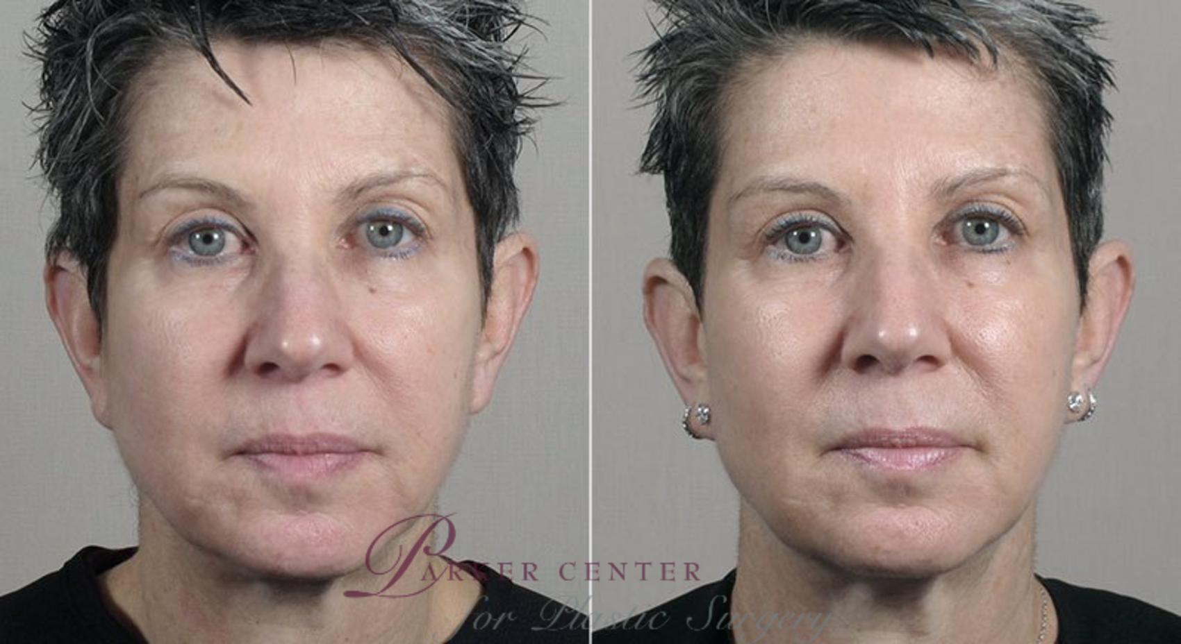 Nonsurgical Face Procedures Case 317 Before & After View #1 | Paramus, NJ | Parker Center for Plastic Surgery