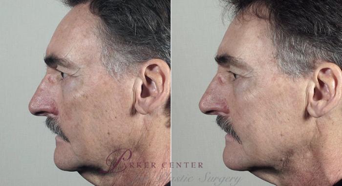 Nonsurgical Face Procedures Case 320 Before & After View #1 | Paramus, NJ | Parker Center for Plastic Surgery