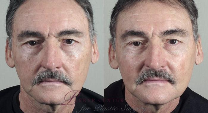 Nonsurgical Face Procedures Case 320 Before & After View #2 | Paramus, NJ | Parker Center for Plastic Surgery