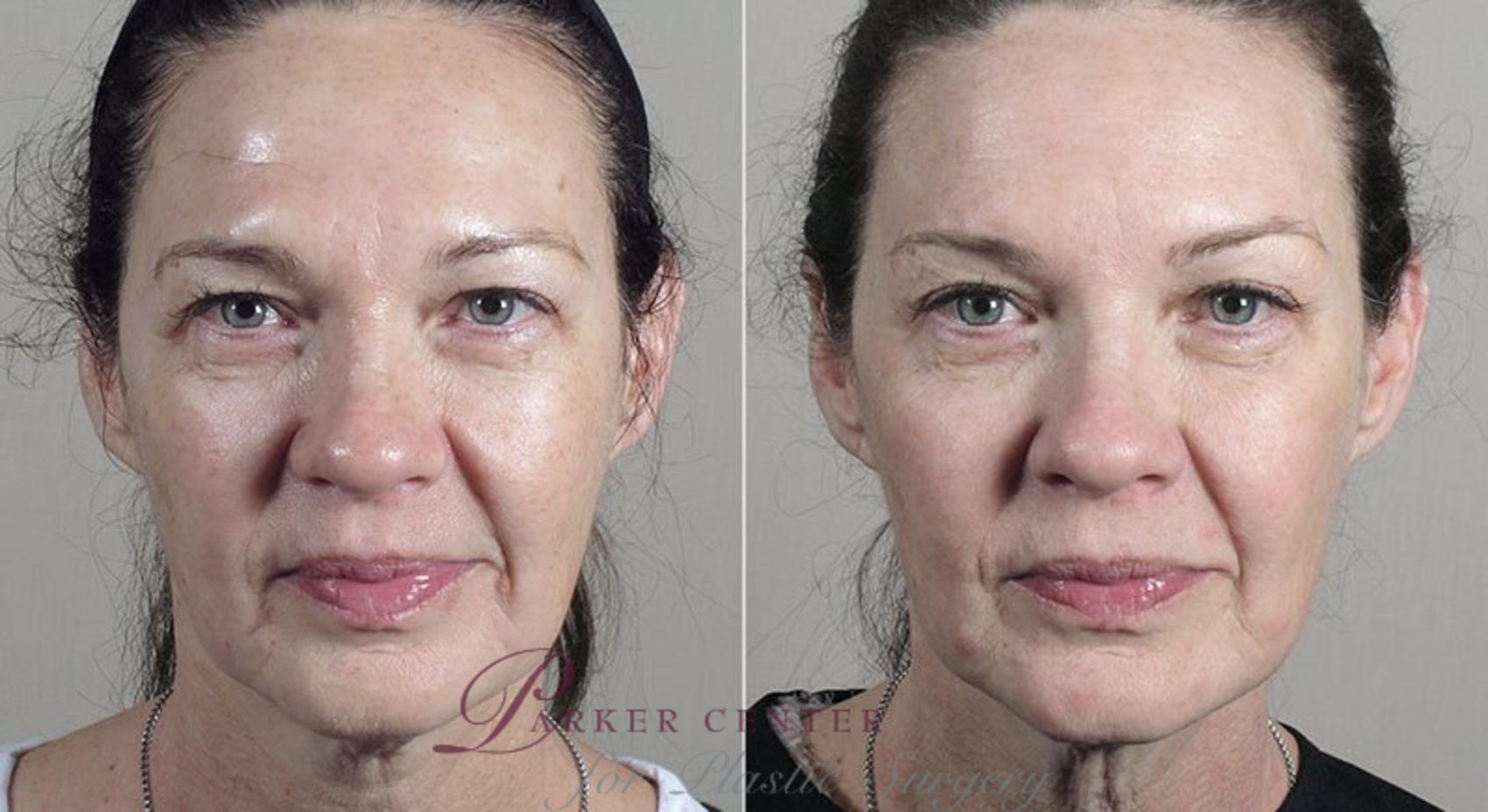 Nonsurgical Face Procedures Case 322 Before & After View #1 | Paramus, NJ | Parker Center for Plastic Surgery