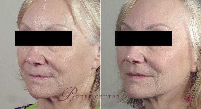 Nonsurgical Face Procedures Case 326 Before & After View #2 | Paramus, NJ | Parker Center for Plastic Surgery