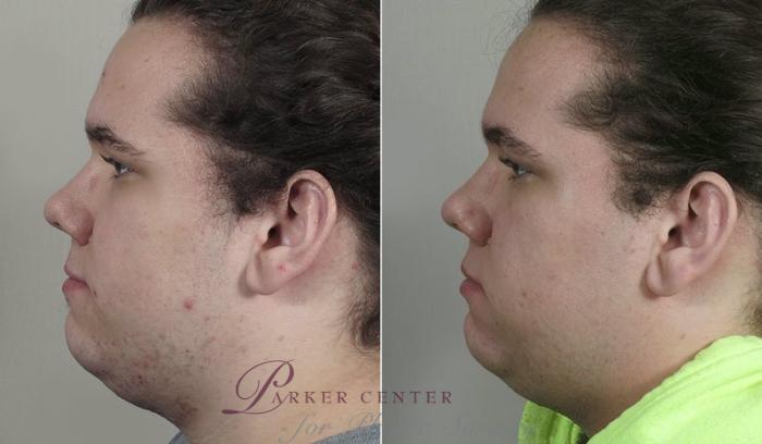 Nonsurgical Face Procedures Case 328 Before & After View #4 | Paramus, NJ | Parker Center for Plastic Surgery