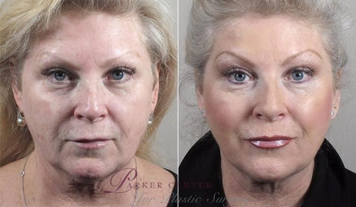 Nonsurgical Face Procedures Case 329 Before & After View #2 | Paramus, NJ | Parker Center for Plastic Surgery