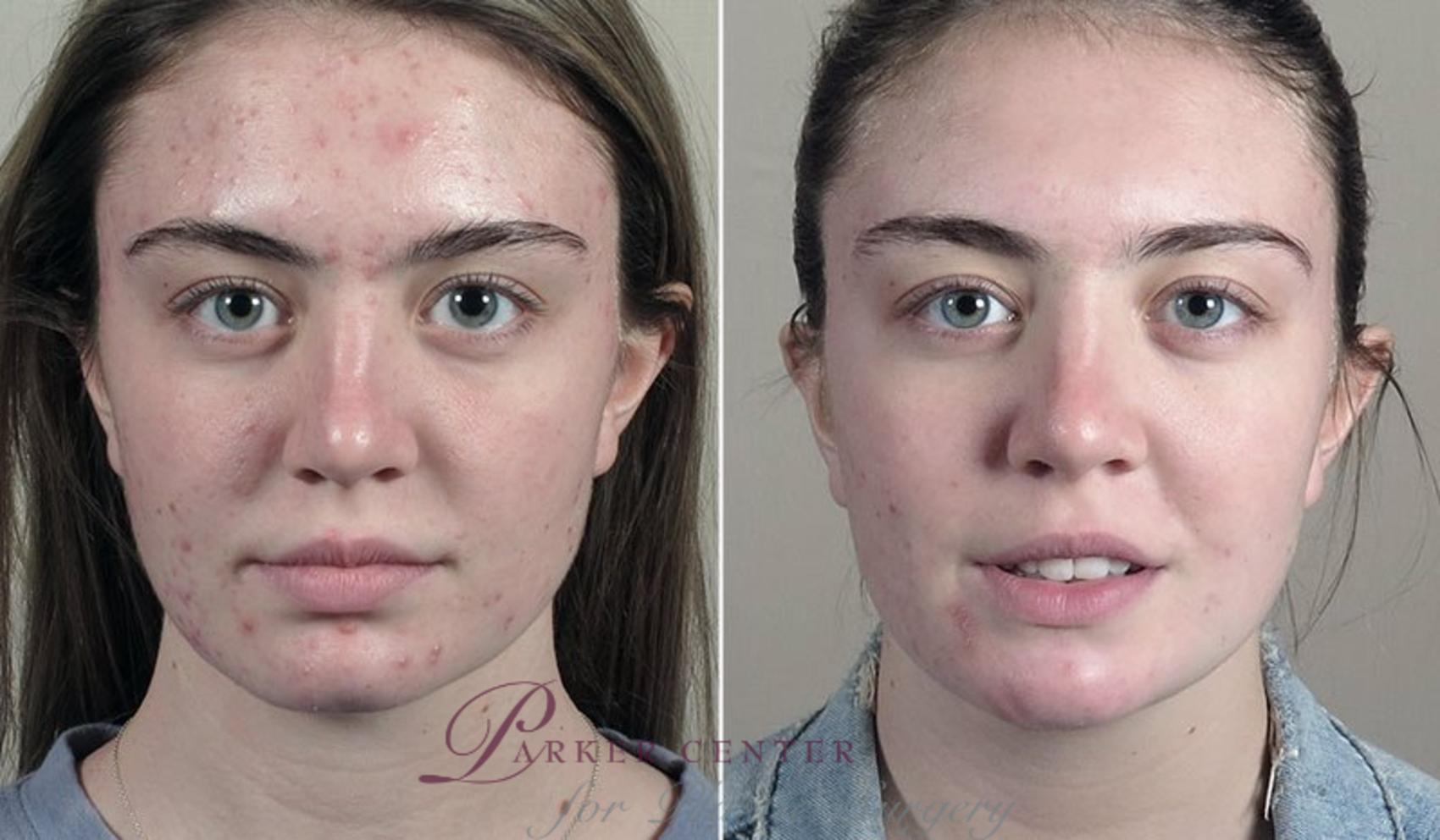 Nonsurgical Face Procedures Case 330 Before & After View #1 | Paramus, NJ | Parker Center for Plastic Surgery
